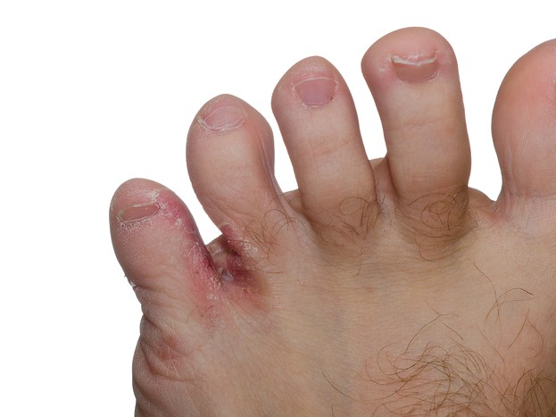 Fußpilz (Tinea Pedis)