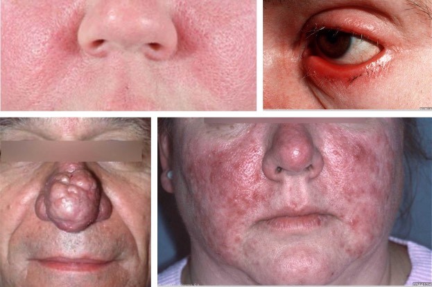 Rosacea, die unbekannte Volkskrankheit