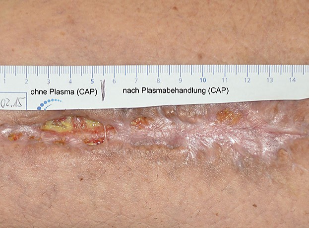 infizierte Hautwunde (mit und ohne Plasmabehandlung)