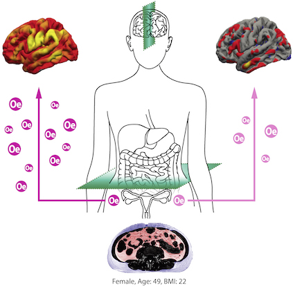 Erhöhtes Organfett (Scan unten) beschleunigt die Alterung von Gehirnnetzwerken. Östradiol (Oe) scheint das Gehirn von Frauen während der Lebensmitte vor strukturellen Schäden (rechts oben).