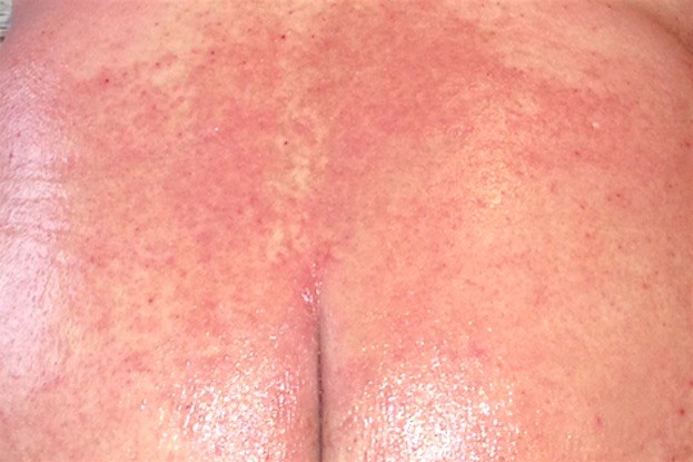 Plaque Psoriasis