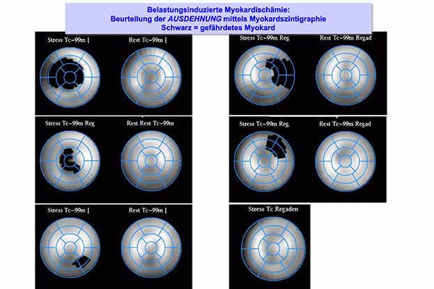Myokard-Szintigrafie