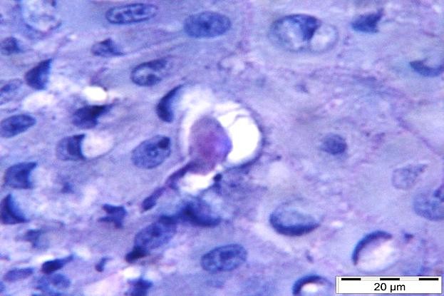 Der Parasit Entamoeba gingivalis dringt ins Zahnfleischgewebe ein und ernährt sich dort von Wirtszellen.