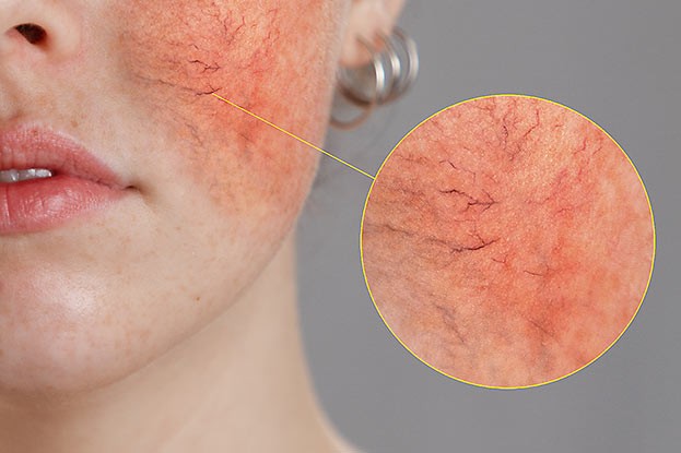 Rosacea (Rosazea)