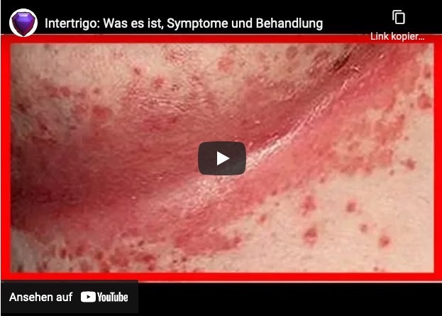 Behandlung intertrigo