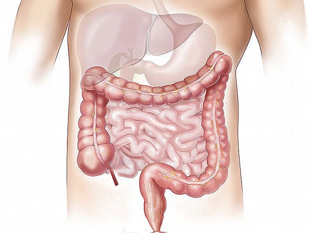 Verschiedene Darmerkrankungen können ein Stoma nötig machen.