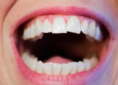 Schöne Zähne wünscht sich jeder! - ©Pixabay