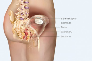 Beckenboden-Schrittmacher - ©Aktion Meditech