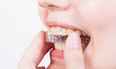 Aligner - die unsichtbare Zahnspange - ©vvoennyy / 123RF.com
