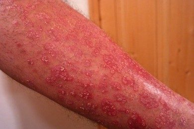 Schuppenflechte, auch Psoriasis genannt, ist eine schmerzhafte Hauterkrankung - ©Pixabay_Hans