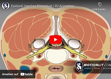 Transforaminale epidurale Injektion ((TFESI) - MotionLit