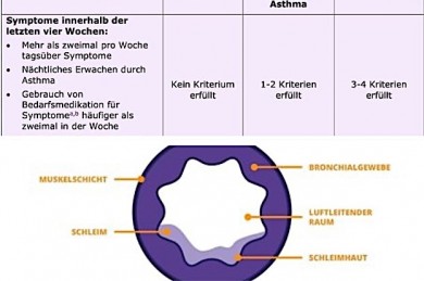 Oben ---> Schweregrade bei Asthma
Unten --> Bronchie im Querschnitt ohne Asthma - ©Sanofi Deutschland 