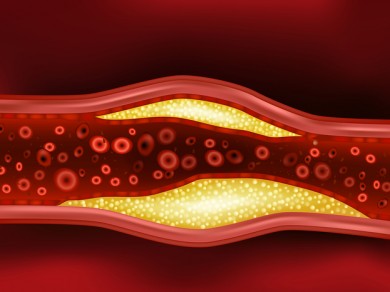 Cholesterin Plaque Der Arterie - ©Sakurra by Depositphotos