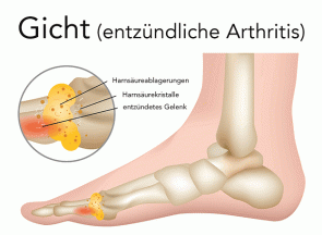Gicht (entzündliche Arthritis) - ©Giggswalk by Depositphotos