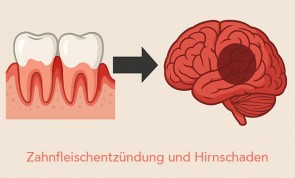 Zahnfleischentzündung & Hirnschaden - ©MD AI