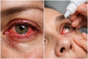 Reizung und Behandlung des Auges - ©MD AI