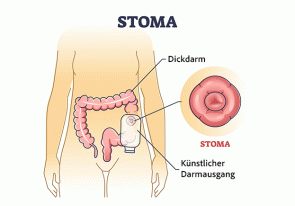 Stoma - ©VectorMine by Depositphotos