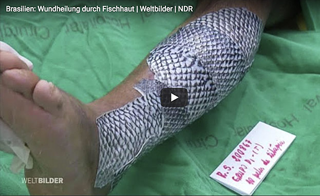 Wundheilung durch Fischhaut