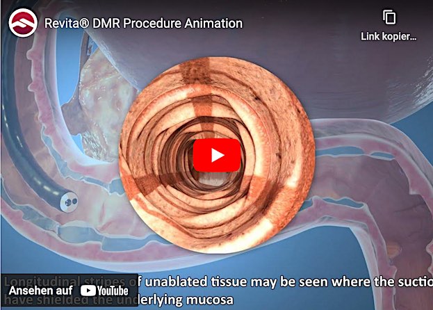 REVITA® als neue Therapieoption bei Diabetes-Typ-2