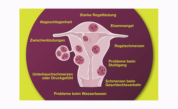 Uterus-Myome | gesundheit.com