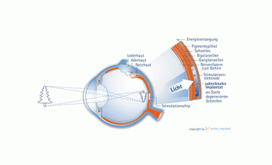 ©Retina Implant GmbH