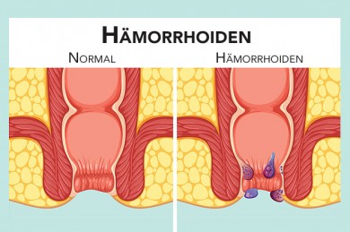 Hämorrhoiden verstehen und behandeln - ©Interactimages by Depositphotos