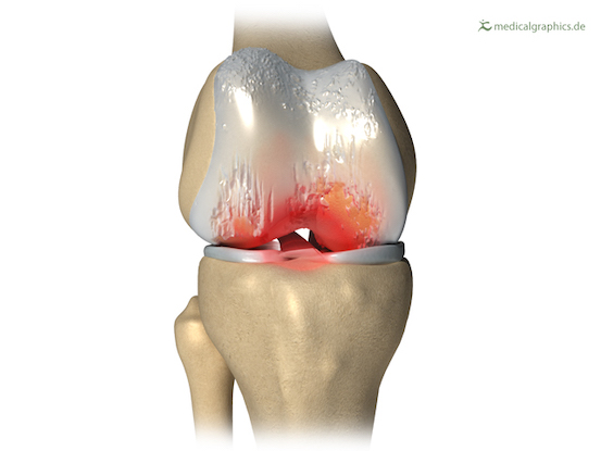 Entzündete Knie-Osteoarthritis