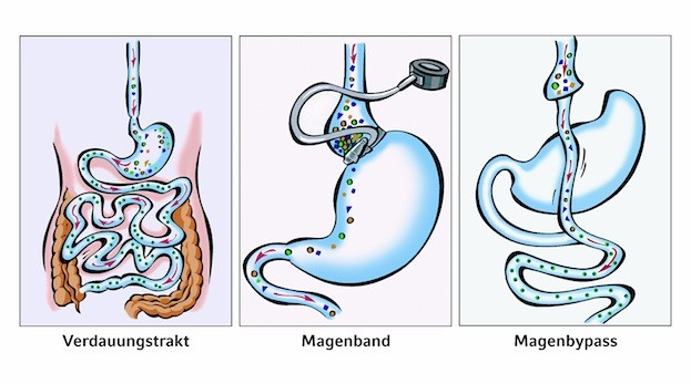 Chirurgische Methoden zur Gewichtsabnahme bei krankhaftem Übergewicht