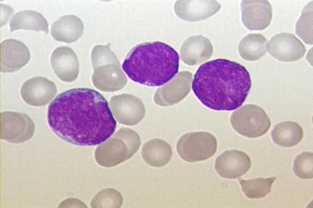 Akute Lymphoblastische Leukämie. Ausstrich des peripheren Blutes. Pappenheim-Färbung, Vergrößerung x100