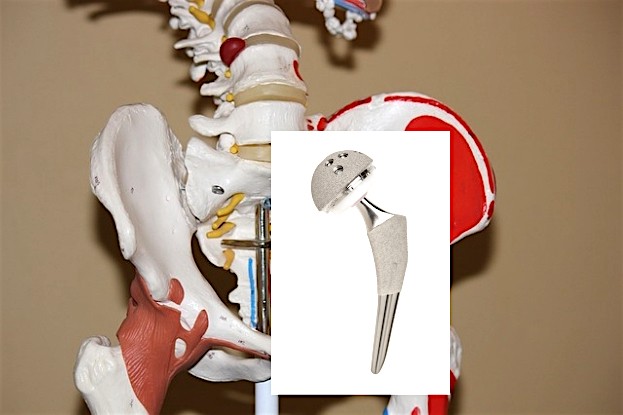 Beispiel für ein Hüftgelenkspfannenimplantat (Accolade II)