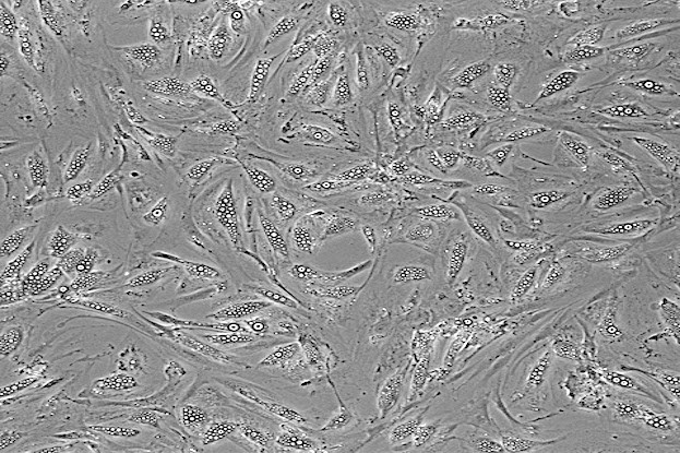 Mikroskopische Aufnahme von humanen Adipozyten, in denen sich Lipidtropfen (weiß) ansammel