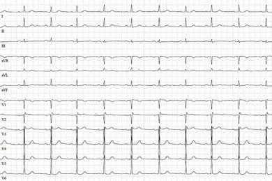 Elektrokardiogramm bei einem akuten Koronarsyndrom ohne ST-Strecken-Hebung  - ©Universitätsklinikum Schleswig-Holstein