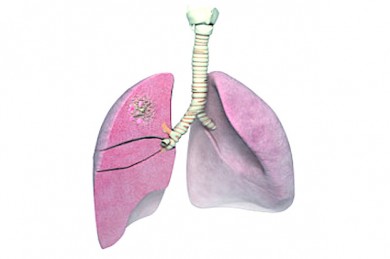 Sichtbares Lungenkarzinom -  ©biolitec®