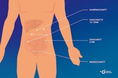 Minimalinvasive Tumorentfernung an Enddarm und Leber - ©Klinikum Ingolstadt